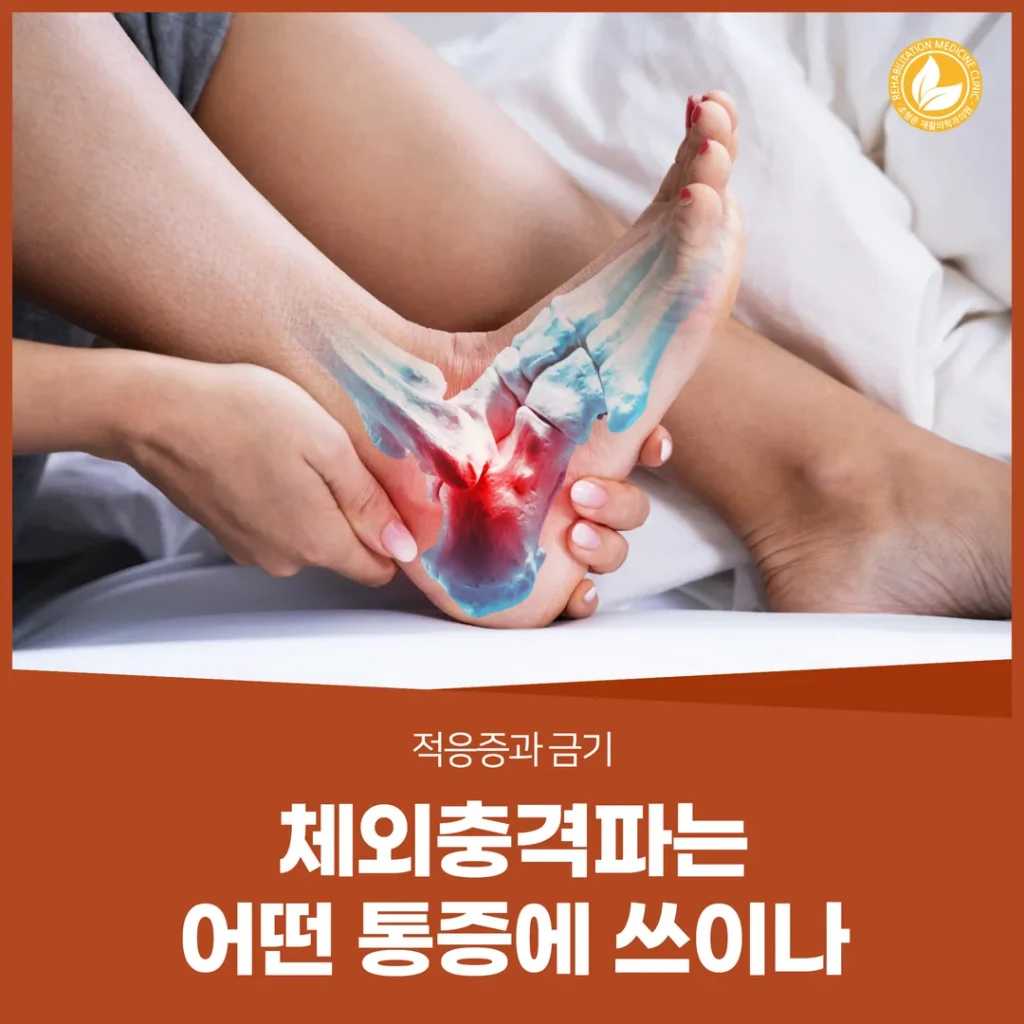 체외충격파는 어떤 통증에 쓰이나 — 적응증과 금기