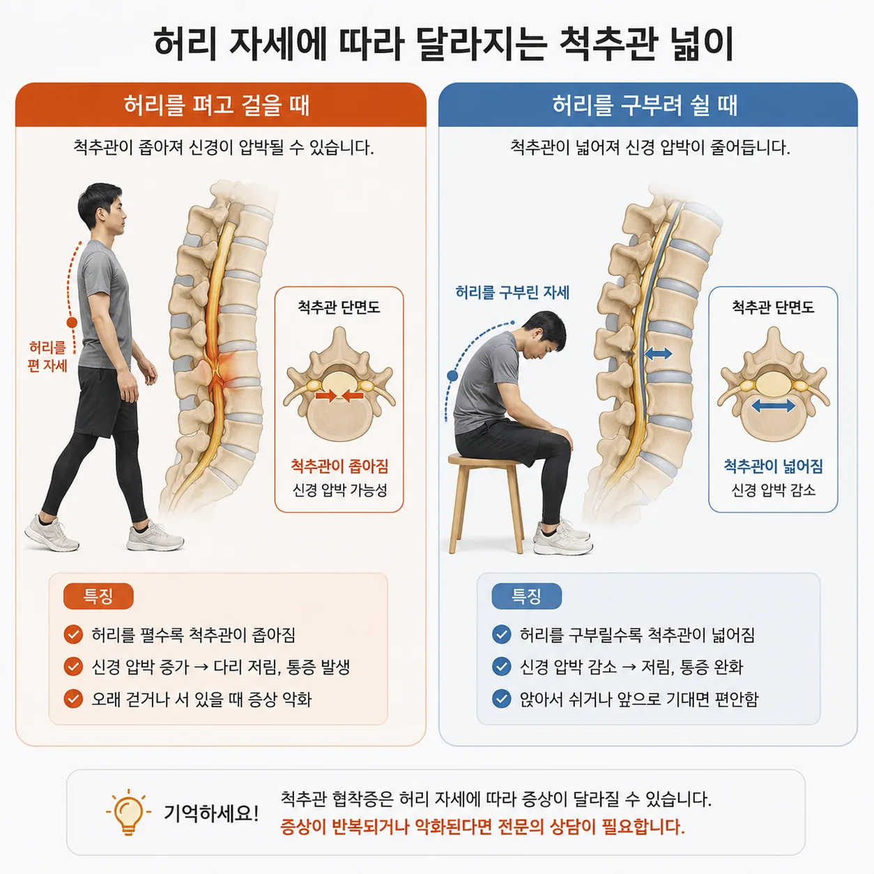 허리를 펴고 걸을 때와 구부려 쉴 때 척추관 넓이가 달라지는 비교 도해