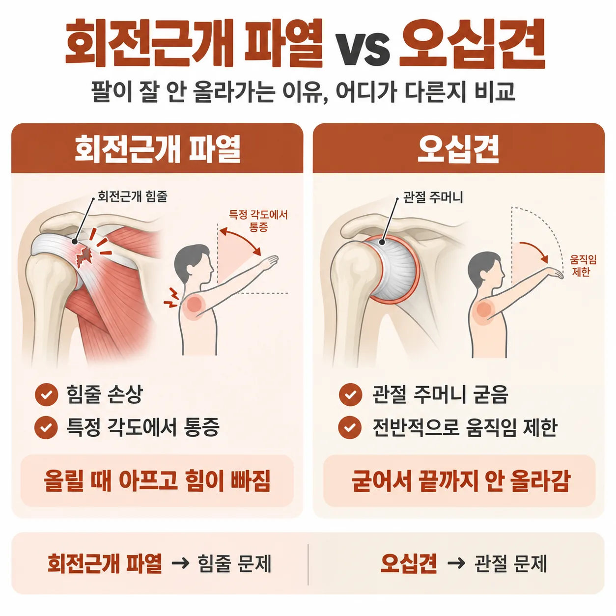 회전근개 파열과 오십견에서 팔이 올라가지 않는 이유를 비교한 개념도