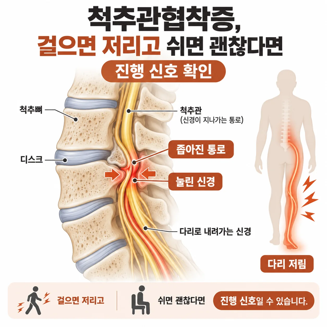 척추관이 좁아져 다리로 내려가는 신경이 눌리는 구조를 나타낸 개념도