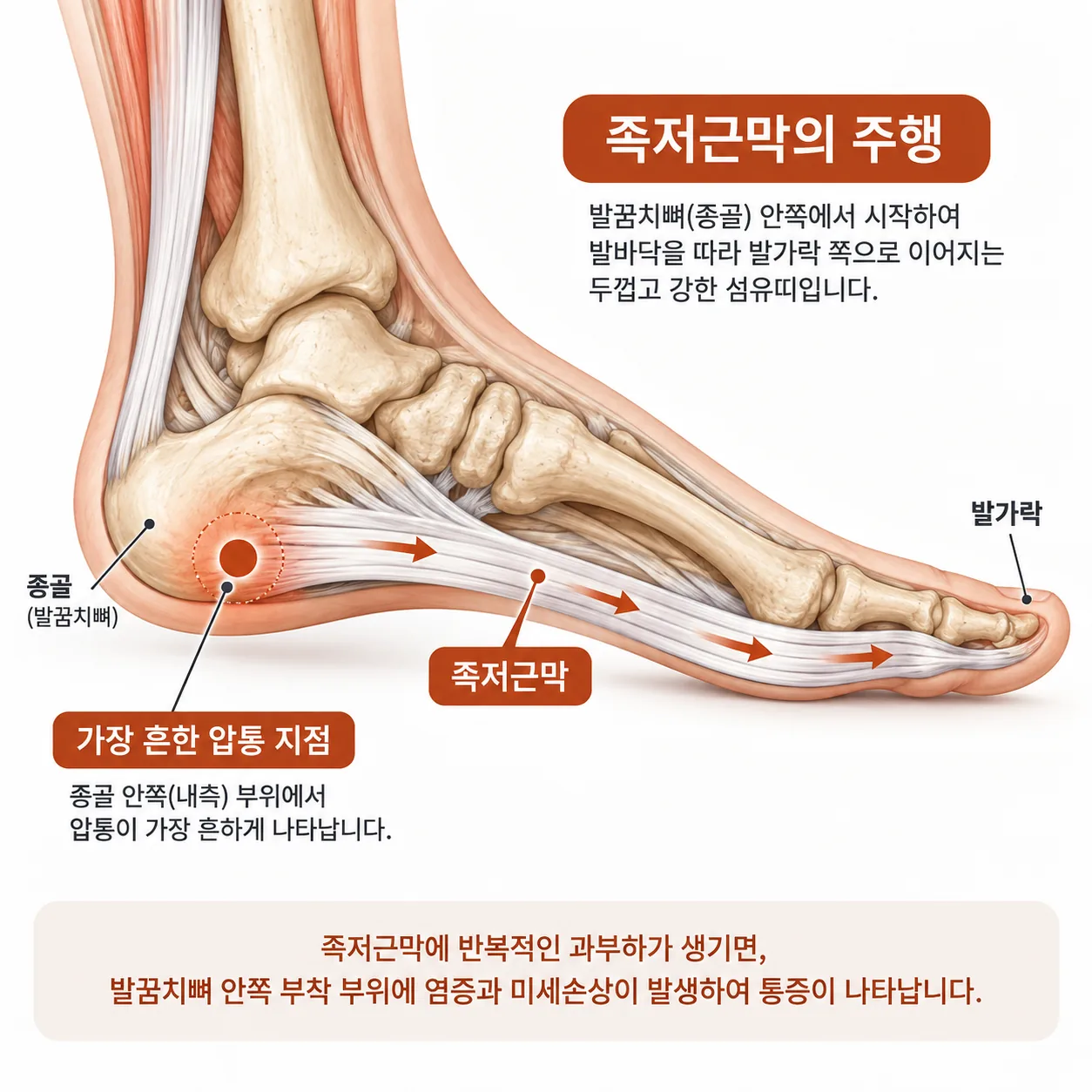 족저근막의 주행과 발꿈치뼈 안쪽 압통 지점을 표시한 개념도