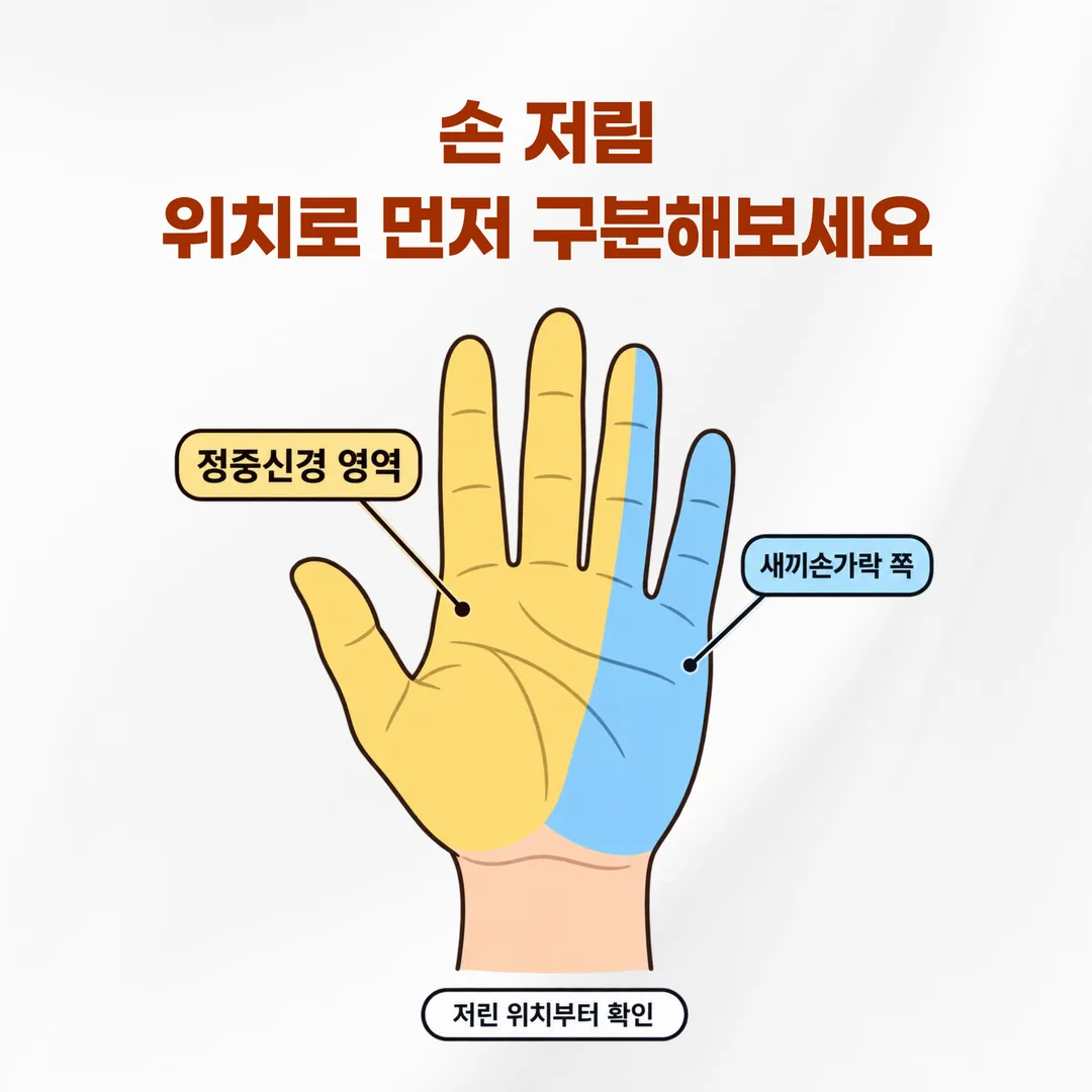 정중신경 담당 영역과 새끼손가락 영역을 색으로 구분한 손바닥 도해