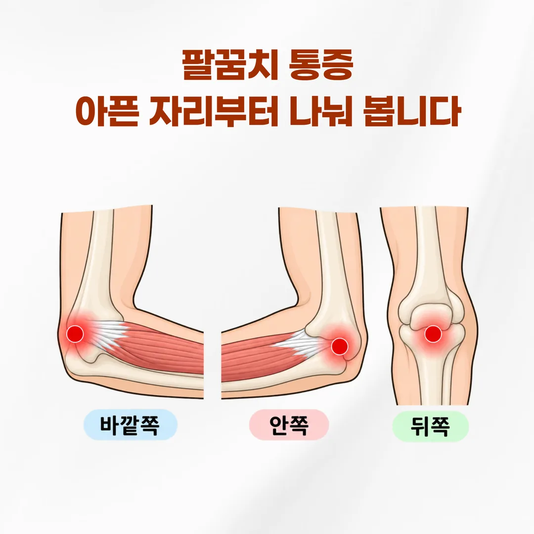 팔꿈치 바깥쪽 압통점과 안쪽 압통점의 위치를 비교한 그림